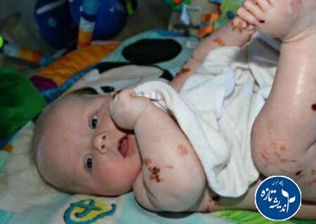 بیماران پروانه ای چشم انتظار حمایت دولت