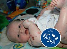 بیماران پروانه ای چشم انتظار حمایت دولت