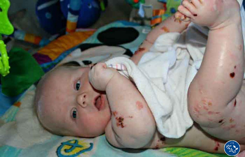 بیماران پروانه ای چشم انتظار حمایت دولت